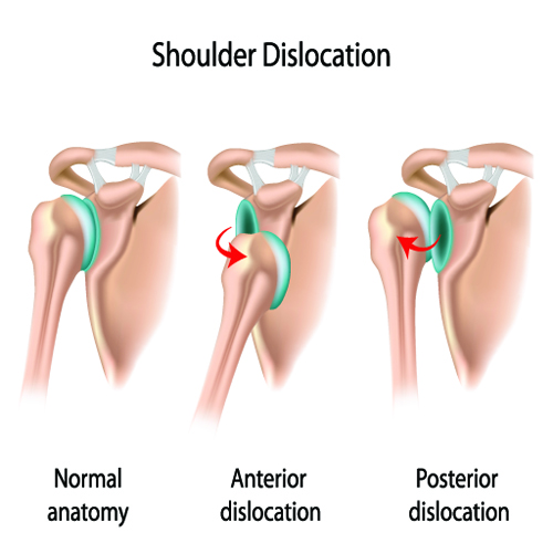 Read more about the article Shoulder Dislocations and how the Results Treatment Method can help!