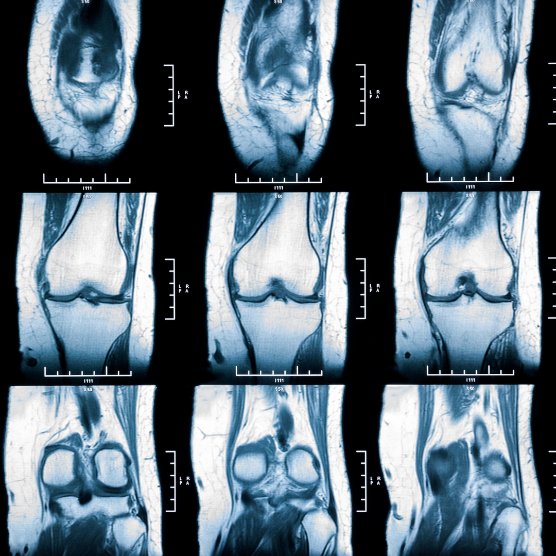 Read more about the article Knees: 3 Injuries and Physical Therapy