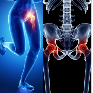 Read more about the article 3 Myths of Hip Pain