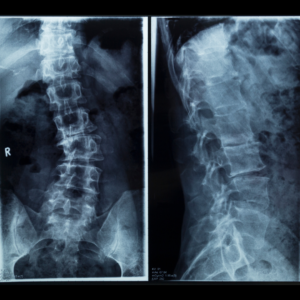 Read more about the article Defying the Curve: Treating Scoliosis